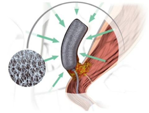 Fig. 3 - La pressione esercitata si distribuisce equamente a tutta la superficie dell’Endo-SPONGE e di conseguenza al tessuto in contiguità con esso