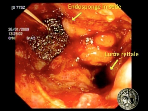 Fig. 4 - Controllo endoscopico del posizionamento