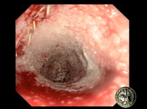 Fig. 5 - Corretto granuleggiamento della superficie della cavità