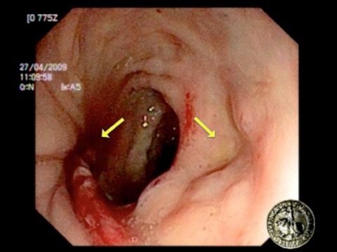 Fig. 6 - Esempio di cavità ascessuale completamente guarita dopo 4 settimane