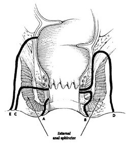 ascessi-e-fistole-anali-3