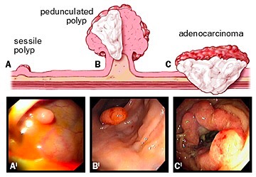A: polipo sessile; B: polipo peduncolato; C: adenocarcinoma, e corrispondenti viste endoscopiche. 