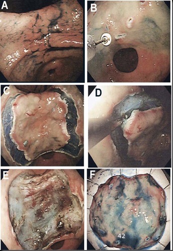 ESD dello stomaco (da Ono et al, Gut, vol 48, 2001 ed Ohkuwa et al, Endoscopy, vol 33, 2001) 