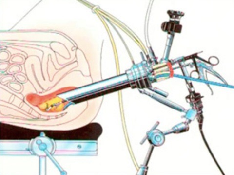 Posizionamento della strumentazione per Transanal Endoscopic Microsurgery