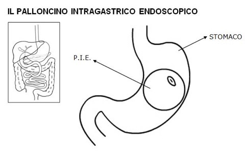 Rappresentazione schematica di B.I.B. o P.I.E. in italiano