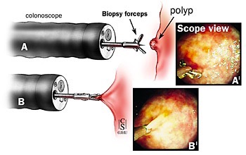 A, B, tecnica endoscopica di biopsia della mucosa del colon, A ', B' corrispondenti visioni endoscopiche