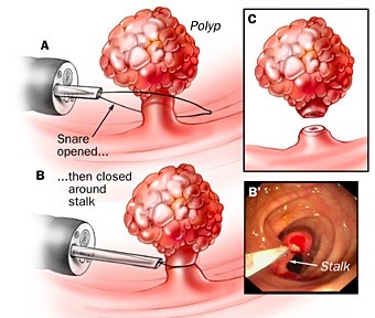 A, B, C, tecnica endoscopica per la resezione di un polipo peduncolato con ansa, B ', corrispondente visione endoscopica. 