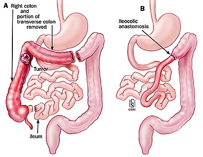 Emicolectomia destra allargata ed ileotrasverso anastomosi con legatura della arteria colica destra e media 