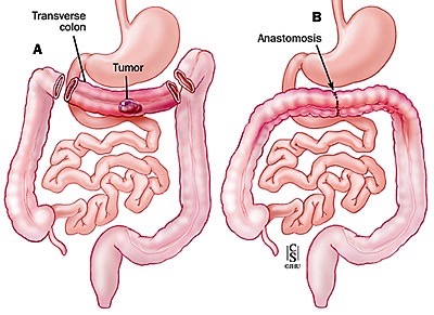 Resezione del trasverso con legatura della arteria colica media