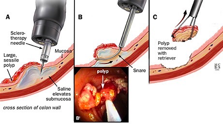 A, B, C, tecnica endoscopica per la polipectomia assistita da iniezione di soluzione salina; B ', corrispondente visione endoscopica.