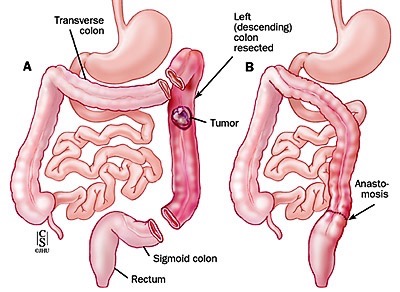 Emicolectomia sinistra con legatura della arteria mesenterica inferiore