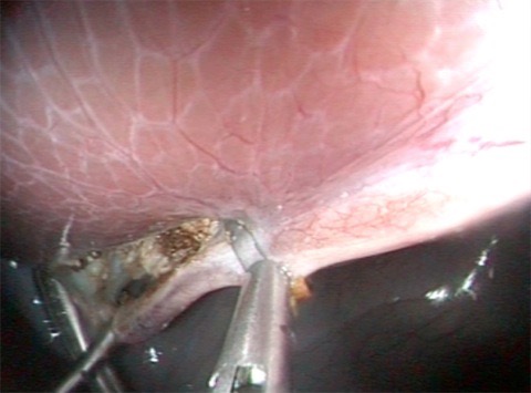 Fig.5 - Chiusura del dotto cistico con clips endoscopiche.