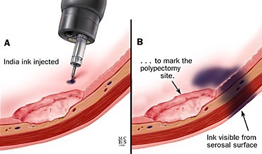 A, B, tecnica endoscopica per marcare un sito di polipectomia per la sorveglianza successiva.