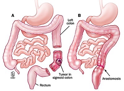 Sigmoidectomia con legatura delle arterie sigmoidee