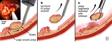 A, B, C, tecnica endoscopica per rimozione frammentaria di un polipo grande con una corrispondente visione endoscopica. 