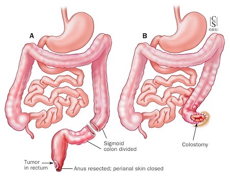Amputazione per via addominoperineale con colostomia terminale sul discendente